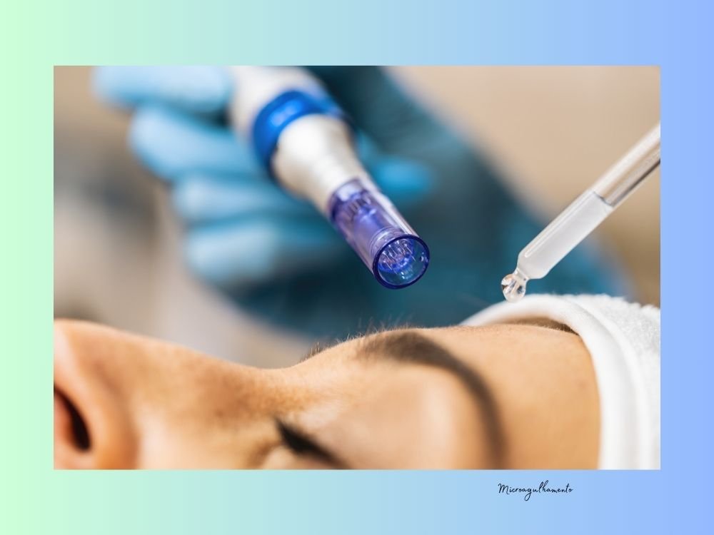 microagulhamento facial benefícios