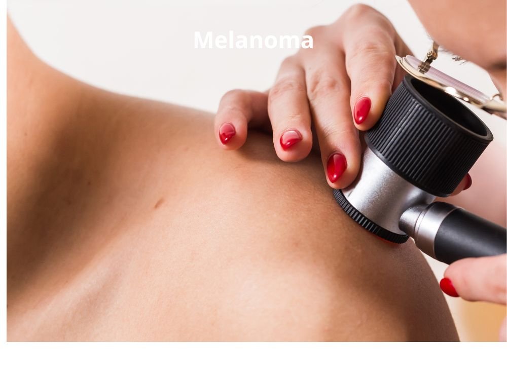 melanoma cancer de pele